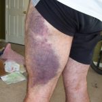 thigh-rear